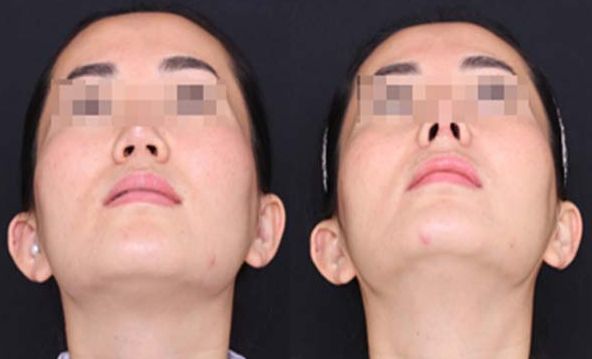 合肥自己的脂肪填充下巴整形醫(yī)院排名前三、前五+費用全新一覽!